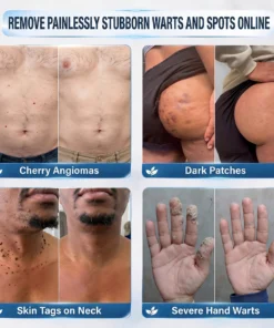 Nexisify® 7-Day Targeted Care for Skin Tags & Dark Spots