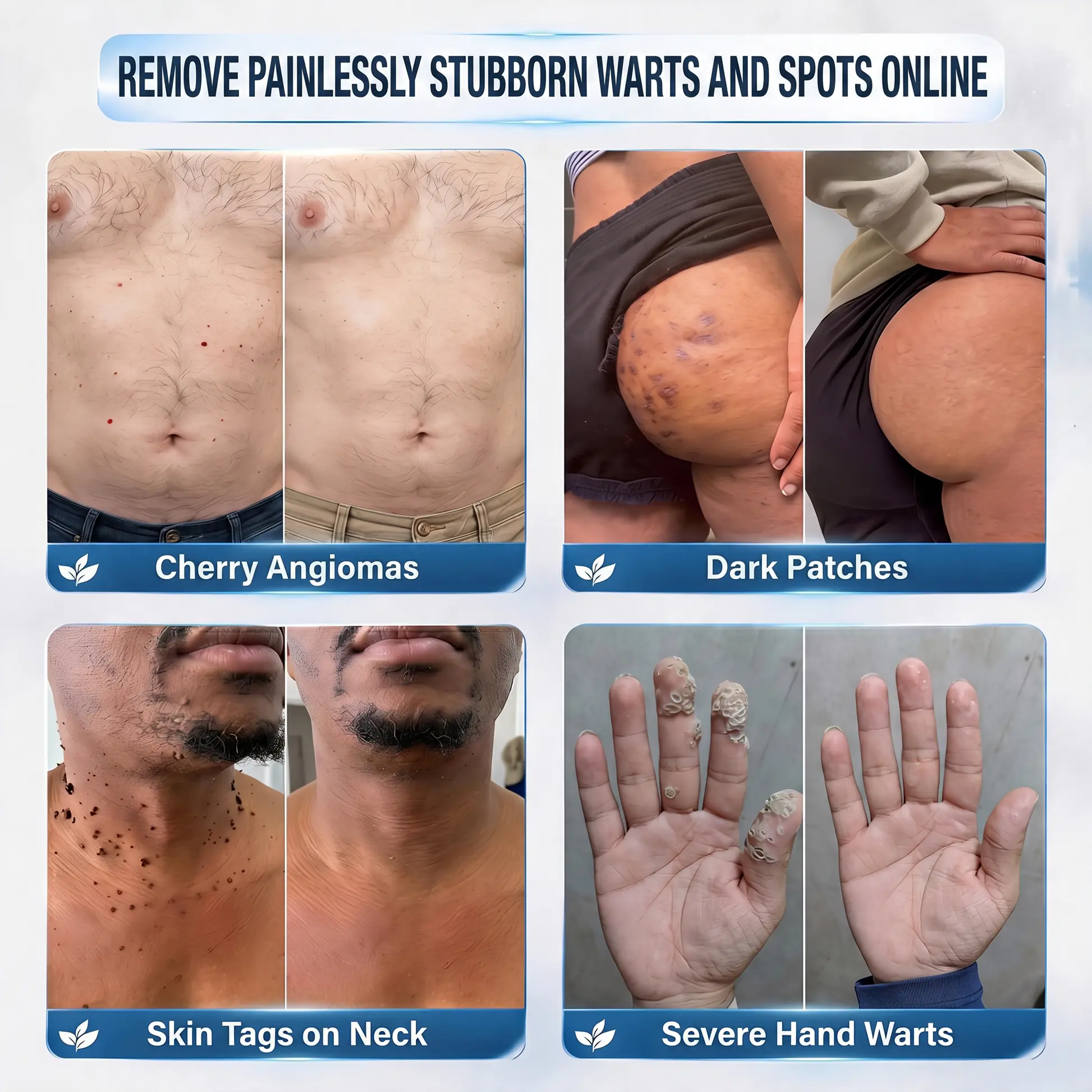 Nexisify® 7-Day Targeted Care for Skin Tags & Dark Spots